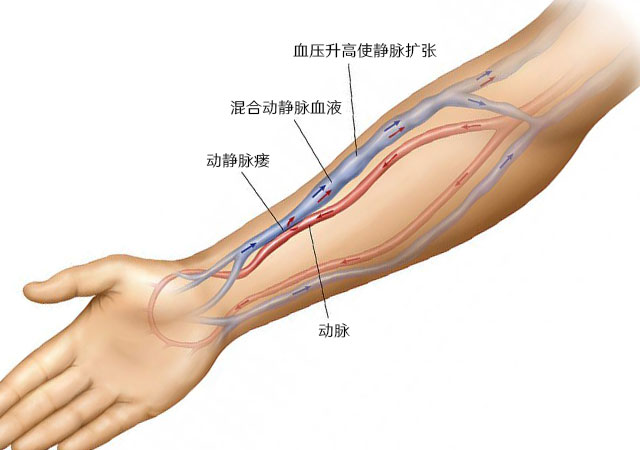 透析做瘘方法动静脉瘘管