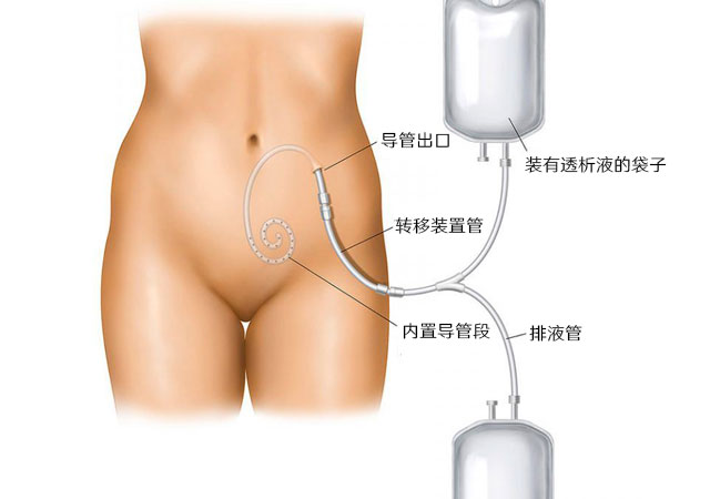 透析做瘘方法腹膜透析导管