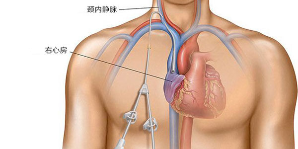 透析做瘘有几种方法类型及优缺点图片