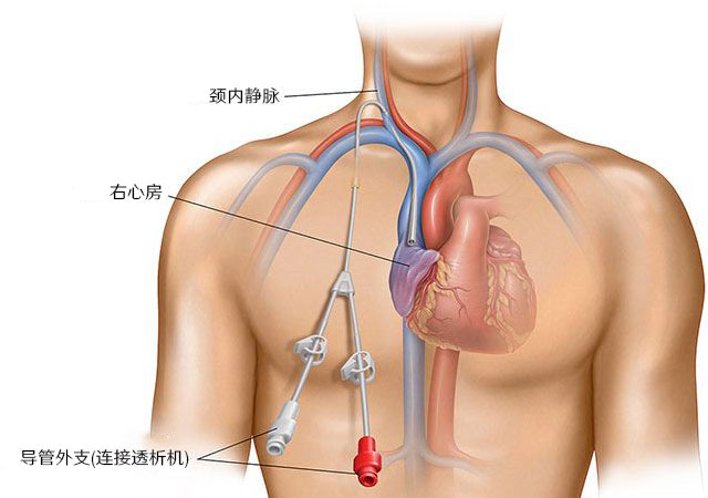 透析做瘘方法中心静脉导管