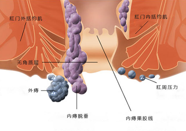 脱垂痔疮图片