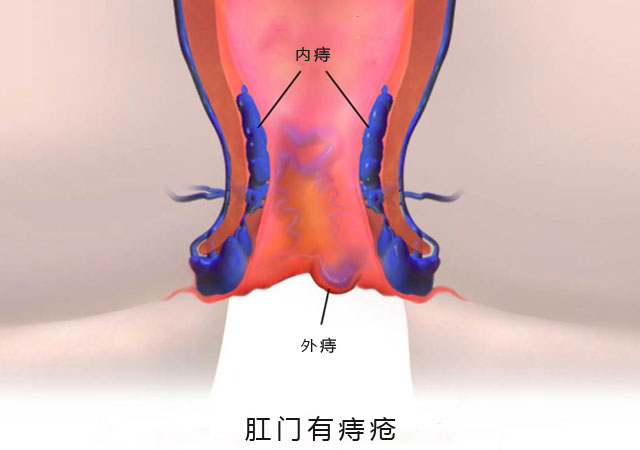 外痔疮图片