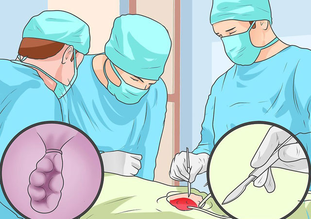 外痔的肉球如何消除的方法之一橡皮筋结扎术