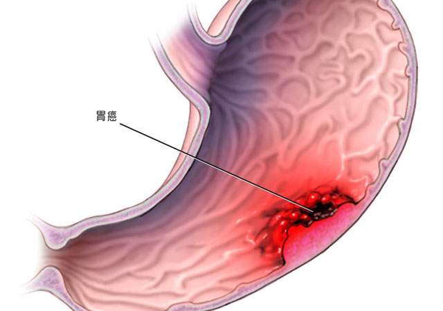 胃癌最常见于排列在胃内部的细胞中