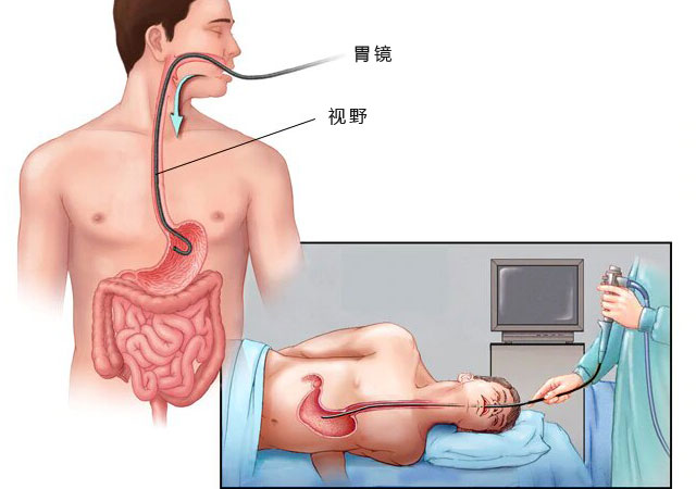 胃镜检查图示