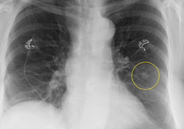 异常胸片显示左中部孤立性肺结节