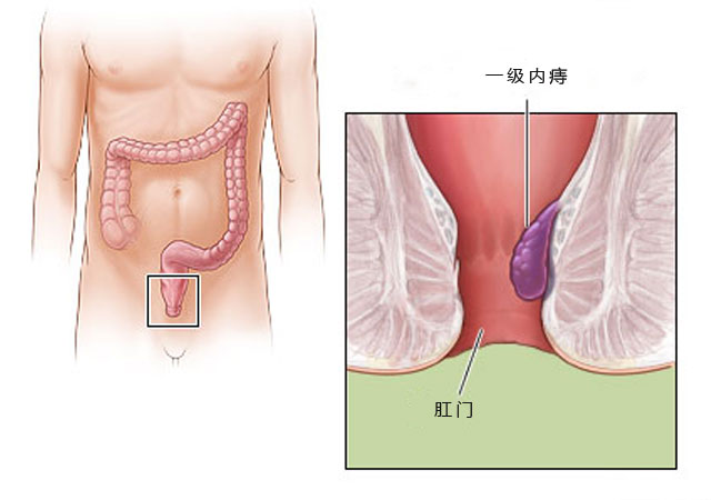 一级轻微内痔疮图片