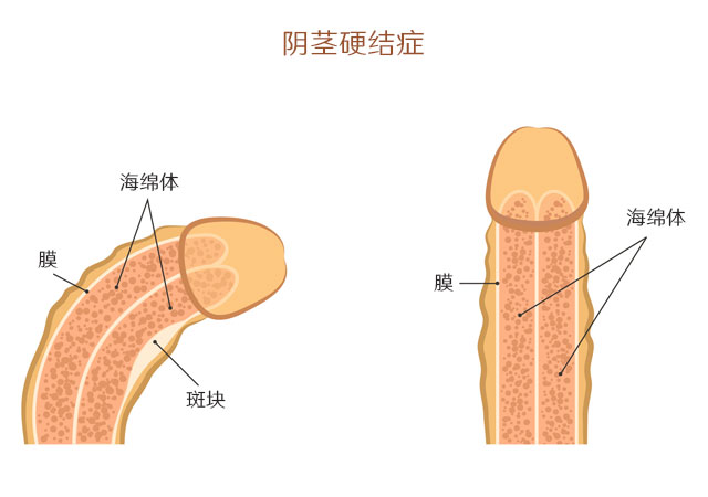 阴茎硬结症示意图