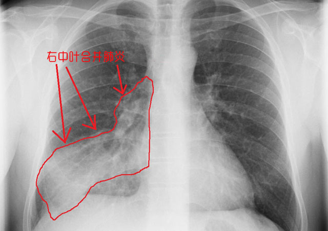 异常胸片显示右肺中叶合并肺炎