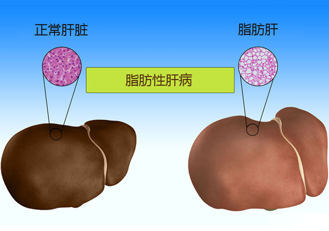 正常肝脏和脂肪肝对比图