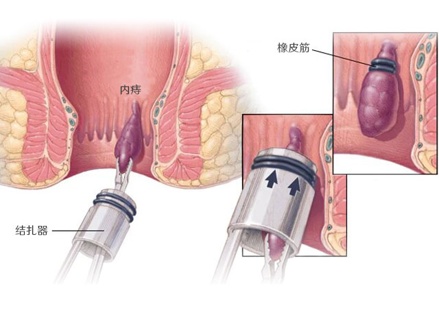 怎么让痔疮肉球缩回去的治疗方法橡皮筋结扎术