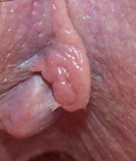 痔疮早期初期旁边有一个无害的皮瓣