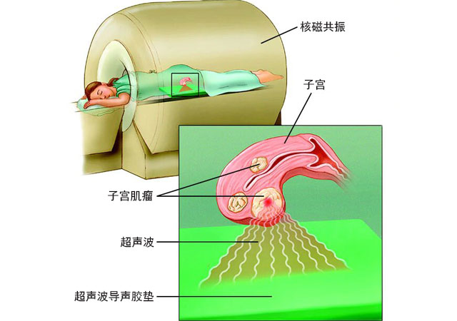 子宫肌瘤聚焦超声手术治疗