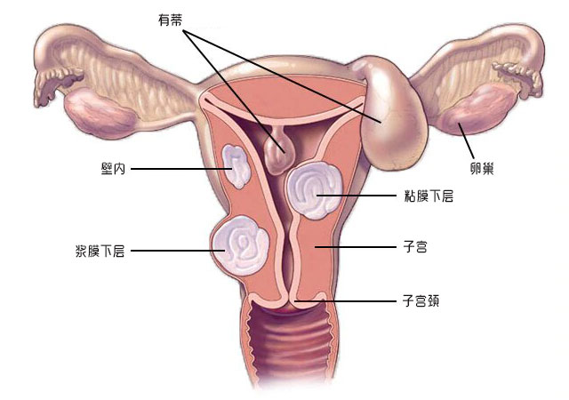 子宫肌瘤位置图