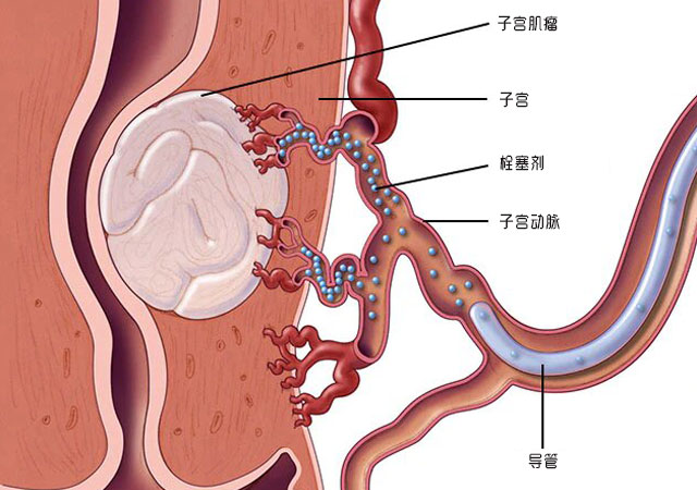 子宫肌瘤子宫动脉栓塞治疗