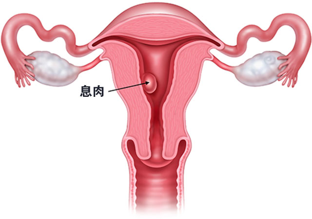 子宫息肉也叫子宫内膜息肉