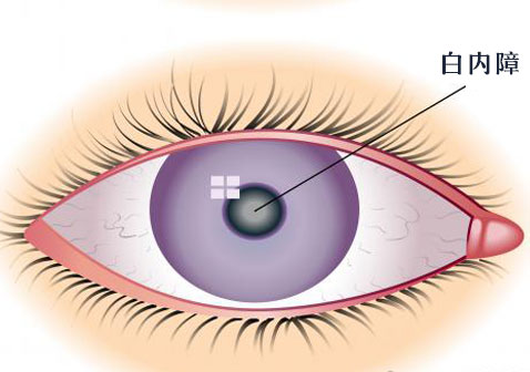 白内障眼睛图片