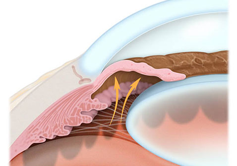 闭角型青光眼症状图片