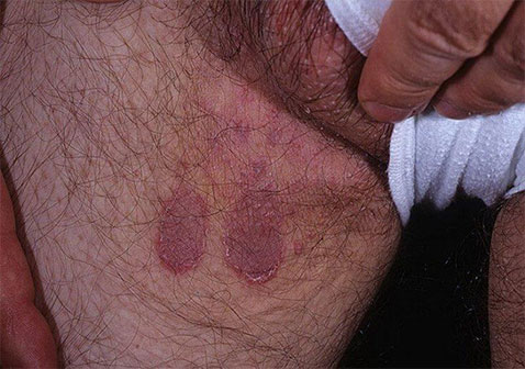 腹股沟大腿内侧牛皮肤癣真实图片症状如何治愈