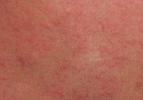 胆碱能性荨麻疹图片