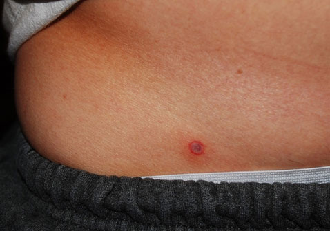 第二阶段梅毒早期症状图片皮疹