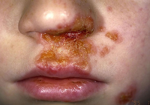 儿童鼻子黄水疮脓疱疮图片