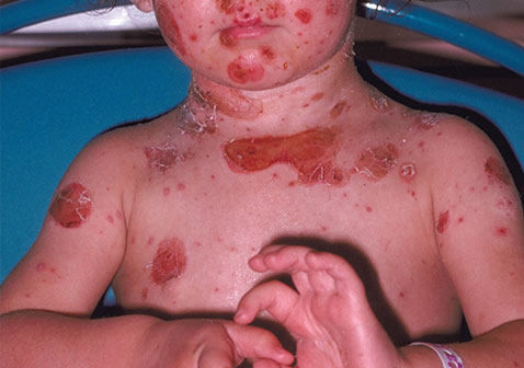 儿童黄水疮脓疱疮严重图片