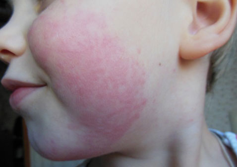 儿童脸上荨麻疹图片和症状