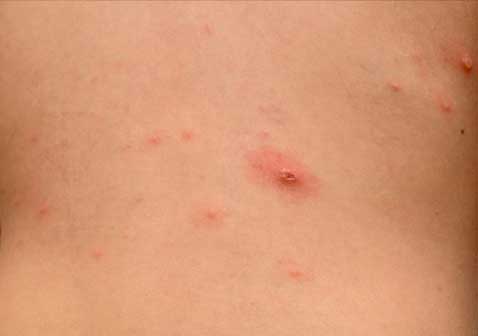 儿童水痘带状疱疹病毒图片