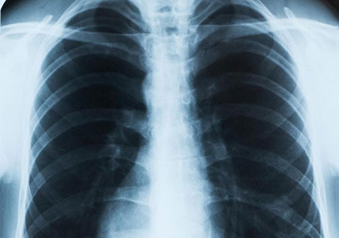 肺结核/肺痨x光图片
