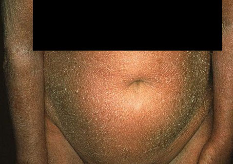 腹部肚子湿疹图片4