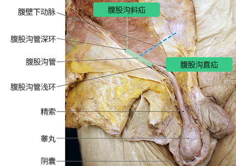 腹股沟位置腹股沟管解剖图片