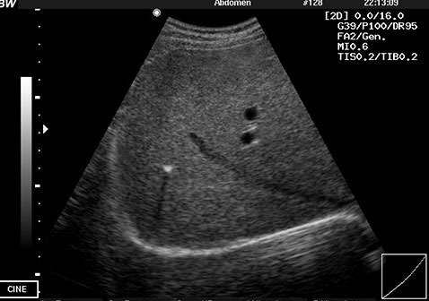 肝内钙化灶超声图片