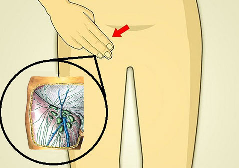 股沟炎症状示意图片