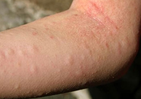 皮肤过敏10种症状图片9皮疹