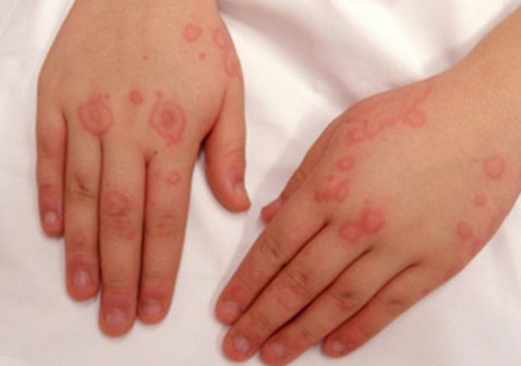 过敏性荨麻疹图片和症状样子