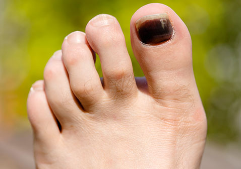 黑脚趾甲症状图片1