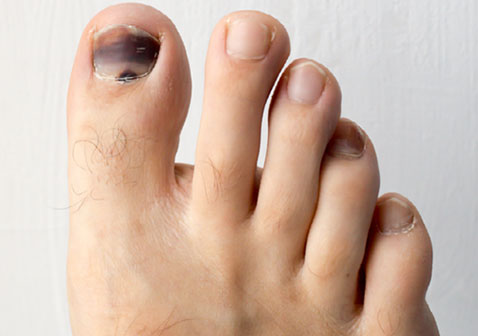 黑脚趾甲症状图片4