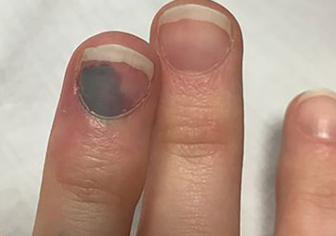 中度黑指甲是什么症状图片