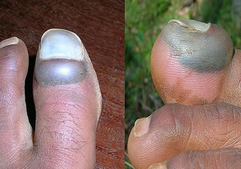 严重黑指甲是什么症状图片