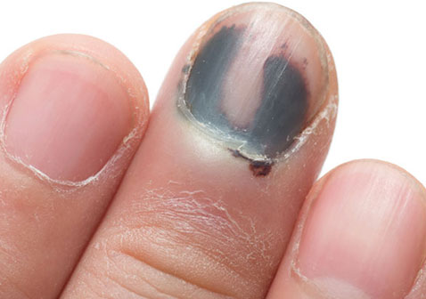 黑指甲是什么症状图片