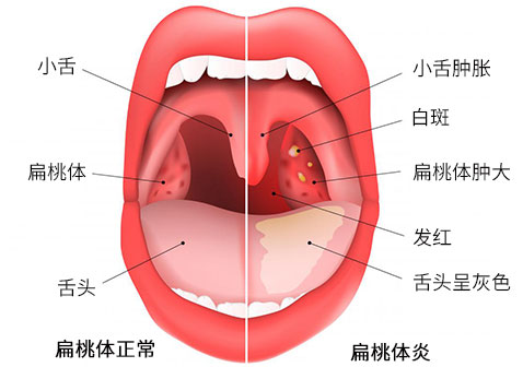 急性扁桃体炎对比图片