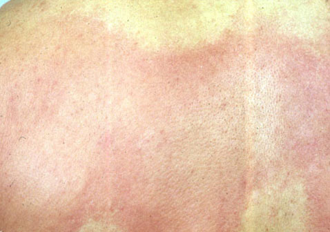 急性过敏性荨麻疹图片2