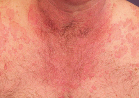 皮肤过敏10种症状图片5发炎