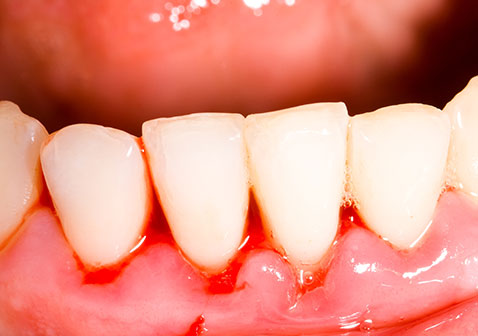 急性淋巴细胞白血病导致牙龈出血图片