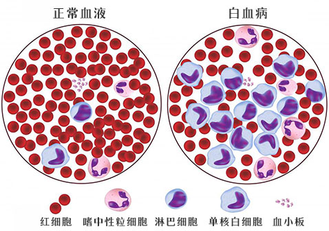急性淋巴细胞白血病图片