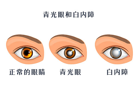 正常的眼睛，白内障和青光眼区别图片