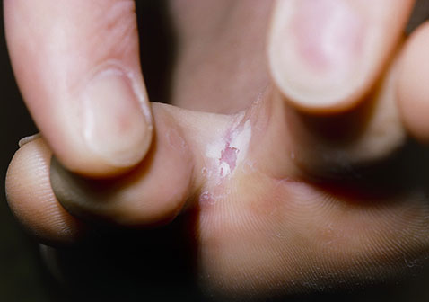 脚部真菌感染症状图片