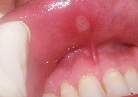 口腔溃疡上嘴唇症状图片