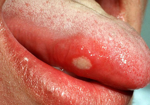 口腔溃疡舌头侧面症状图片